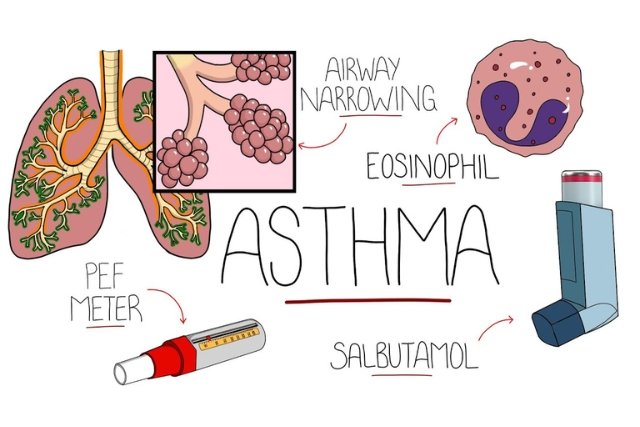 Asthma